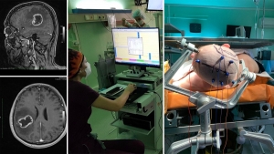 В ОКЛ оперують пухлини головного мозку під спеціальним моніторингом