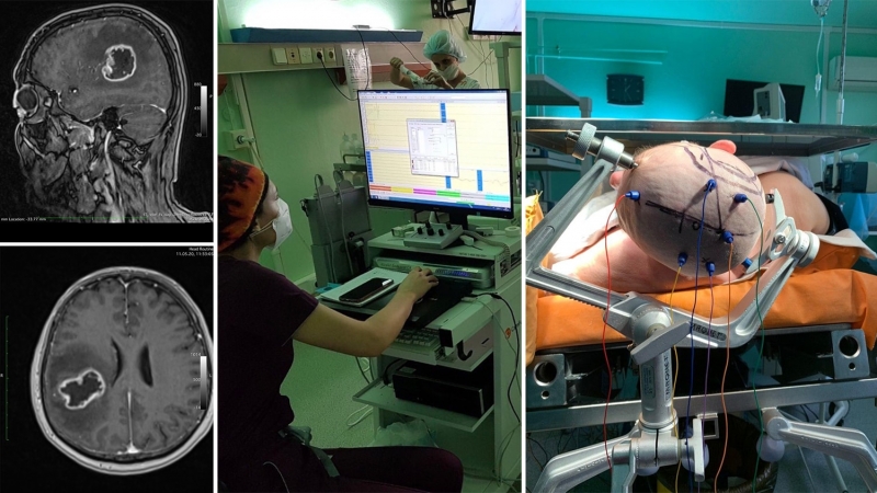 В ОКЛ оперують пухлини головного мозку під спеціальним моніторингом